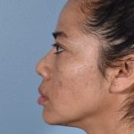 rhinoplasty