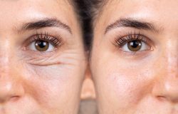 How Much Does Blepharoplasty Cost Near Bethesda