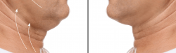 man before and after double chin surgery in chevy chase