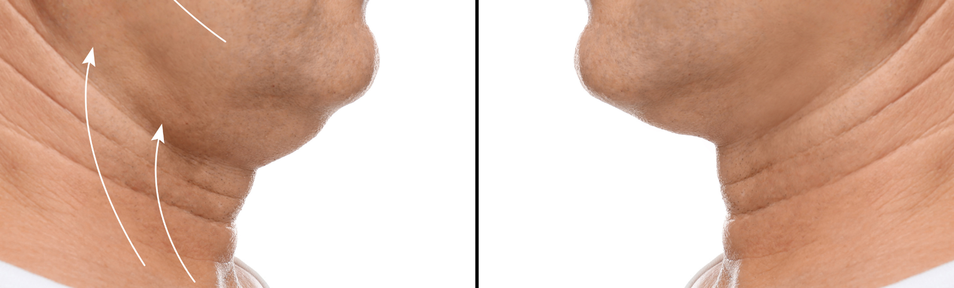 man before and after double chin surgery in chevy chase