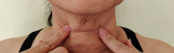woman in need of platysmaplasty in Chevy Chase Maryland
